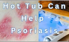 A comparison of skin with psoriasis and a hot tub that can help with the condition.