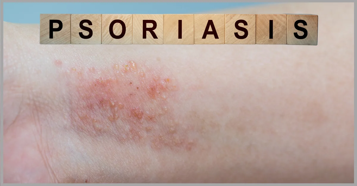 A person’s arm with a patch of psoriasis on the elbow, surrounded by wooden tiles spelling out “PSORIASIS”. (Can hot tubs help with psoriasis)