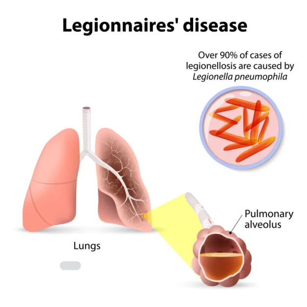 Illustration info for Legionnaires Disease Hot Tub