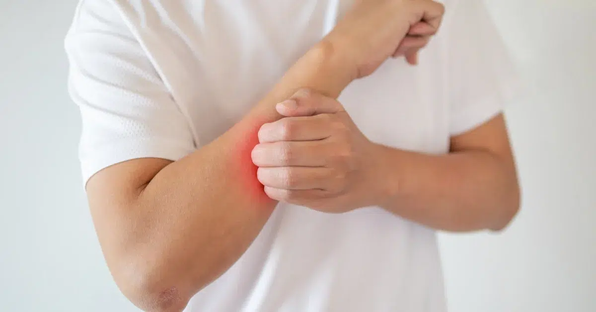 A close-up of a person’s arm with red, inflamed skin and small bumps. (eczema from hot tub)