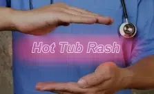 A doctor with a blue shirt showing eczema from hot tub text