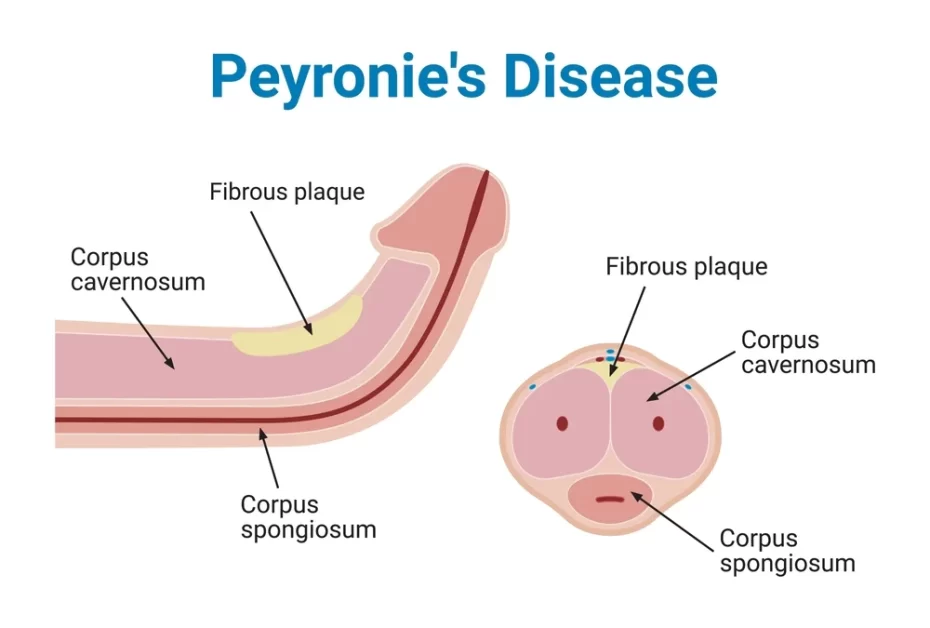 A illustration details explain of  Peyronie's Disease. 