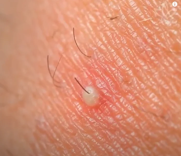 Folliculitis sign on a skin