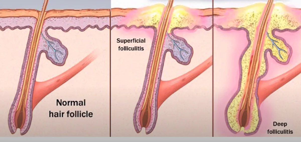 infographics of appearance Folliculitis.