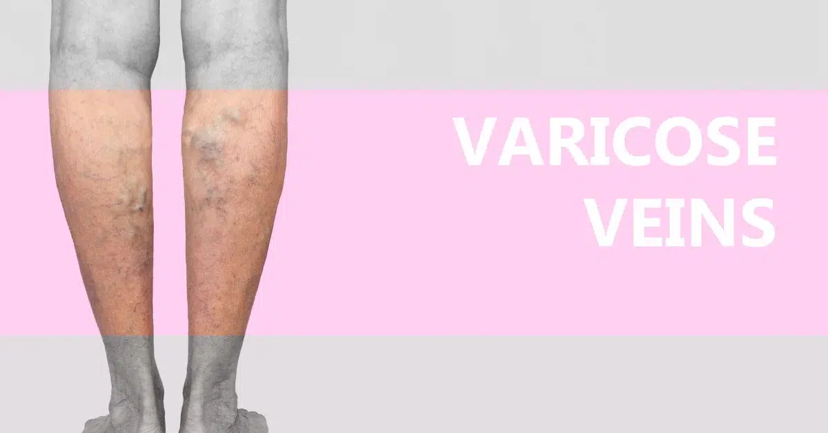 a Varicose Veins position and info text 